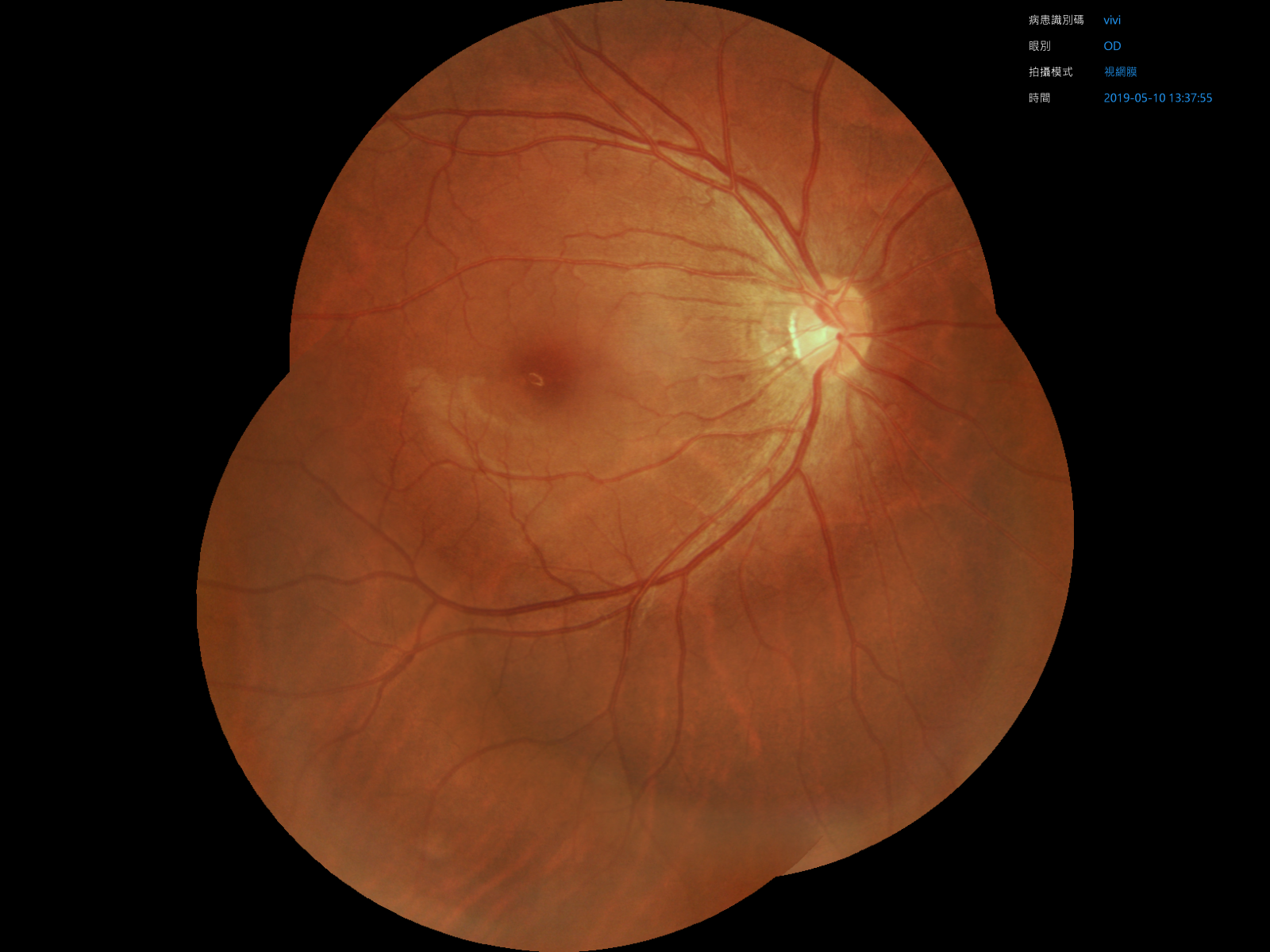 Multi-retinal image mosaics features by Crystalvue NFC-600 Fundus Camera