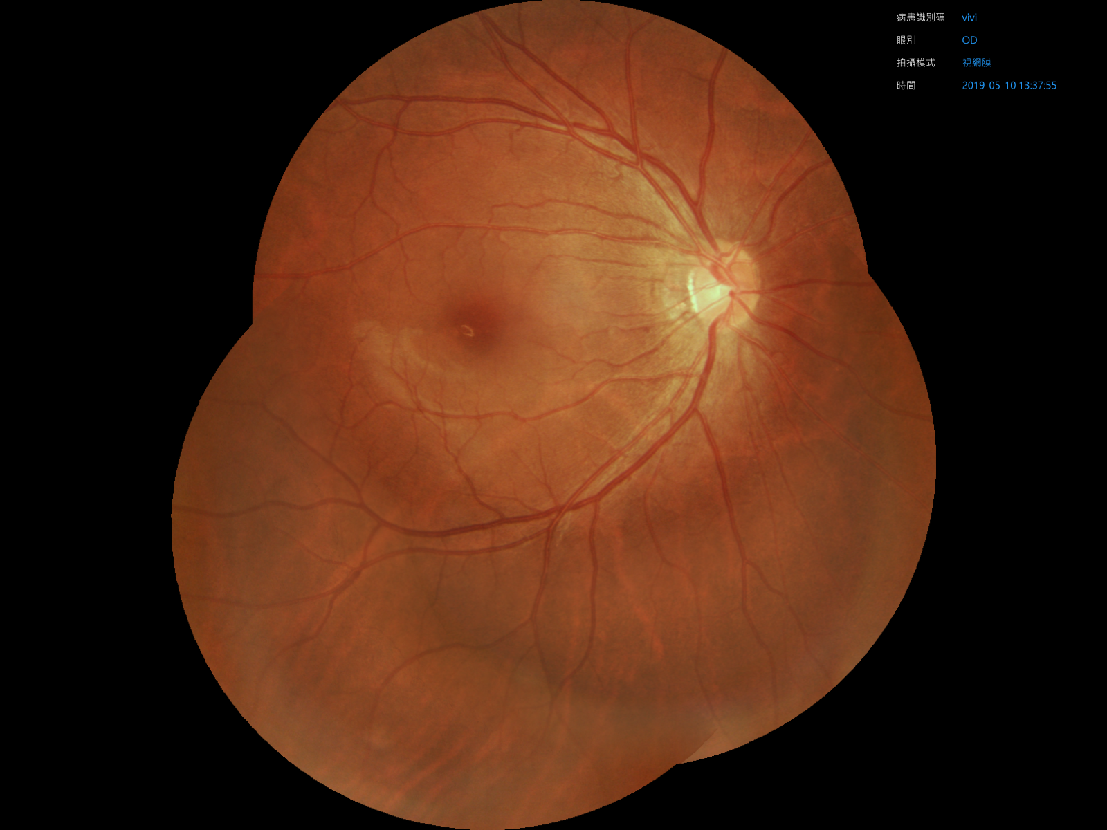 明達眼底攝影機具備高畫質眼底圖影像拼接功能