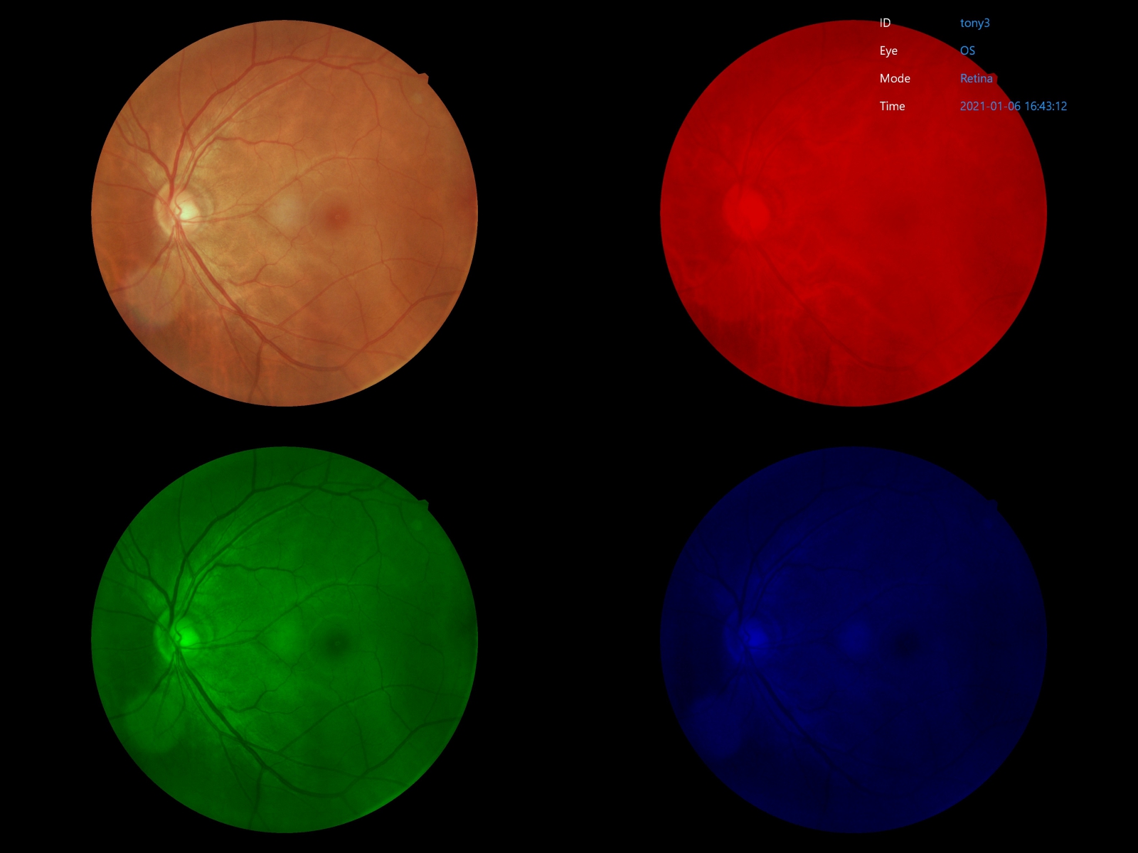 Retinal image built-in filters in Crystalvue NFC-700.