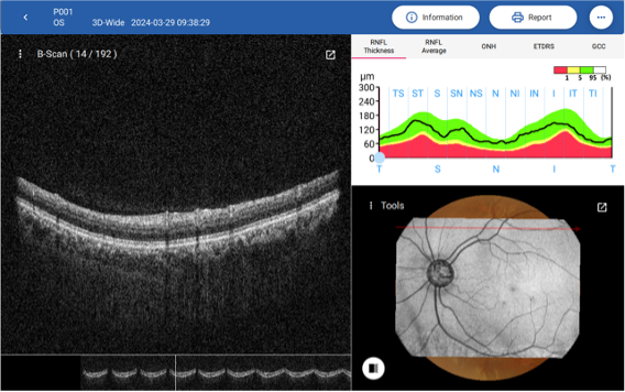明達醫學OCT眼部斷層掃描清晰影像