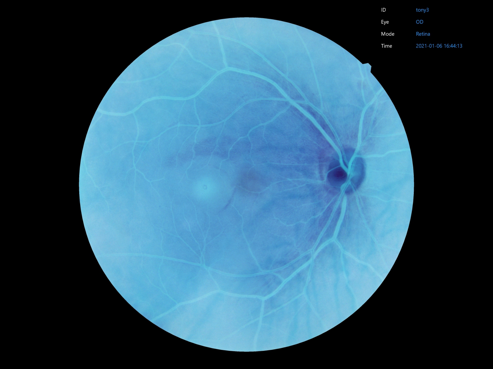 Crystalvue retinal camera provides Built-In Filters for retinal images